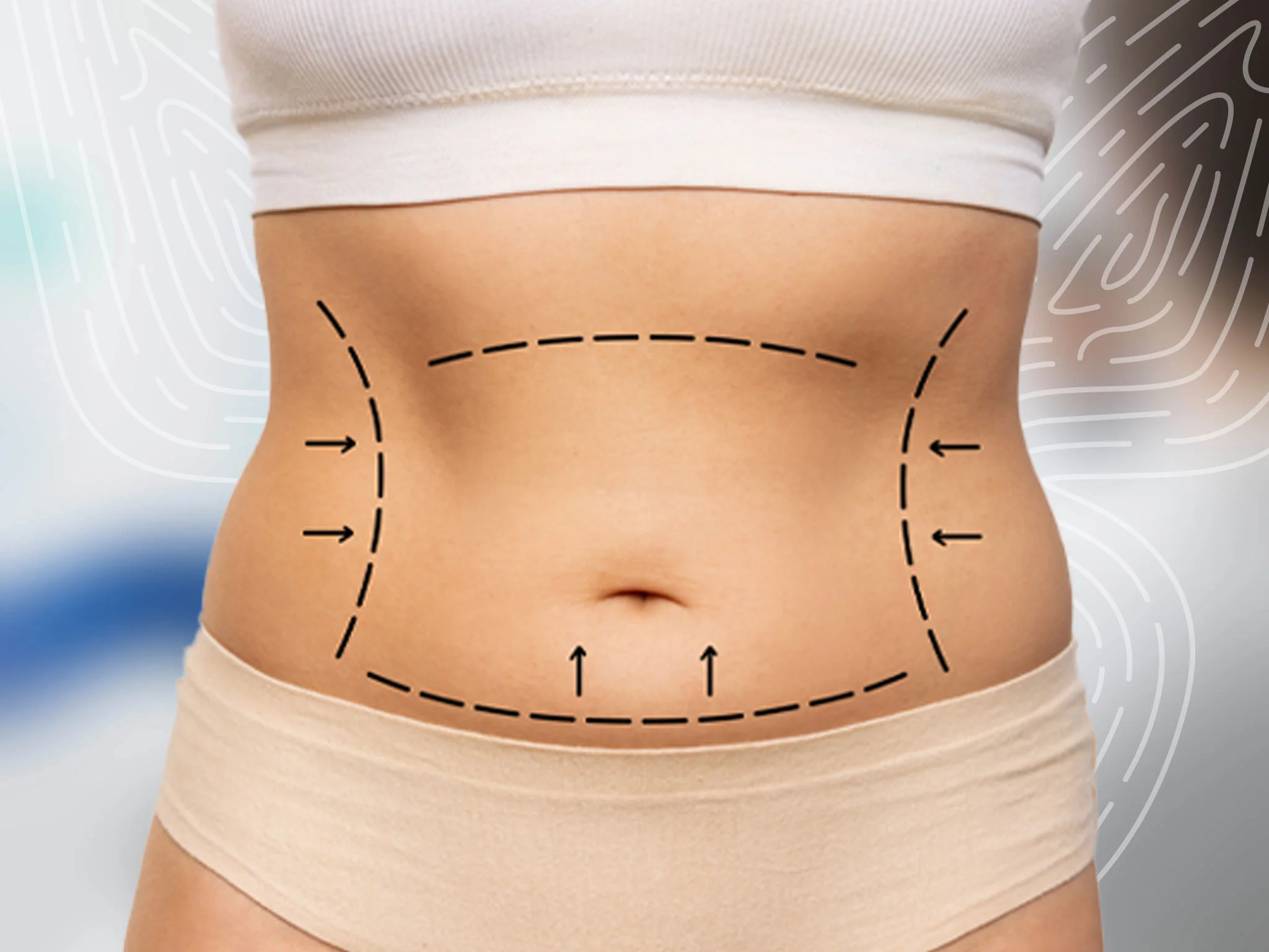 Liposuction