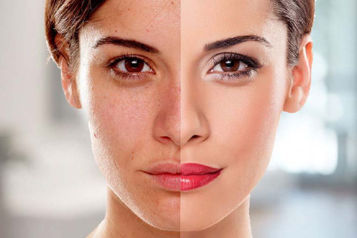 Skin Whitening Treatment